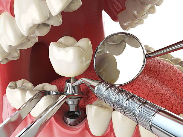 Best Broken or Chipped Tooth Repair in Grafton, OH